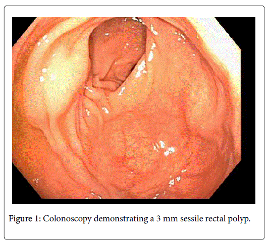 531px x 488px - Rare Primary Sub-Mucosal Rectal Squamous Cell Carcinoma Diagnosed with  Endoscopic Ultrasound: Case Report and Literature Review
