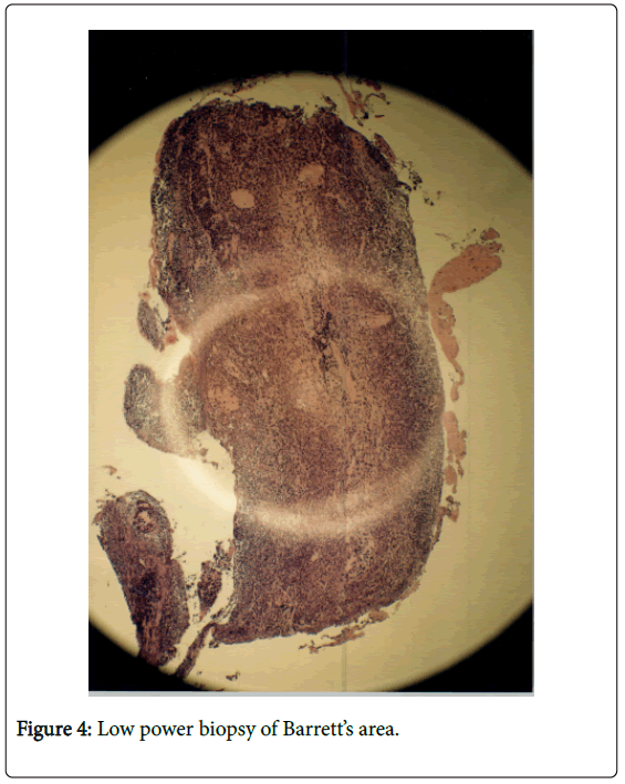 gastrointestinal-digestive-Low-power-biopsy