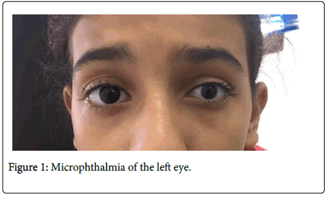 Anophthalmia and Microphthalmia as related to Eye Diseases (General ...