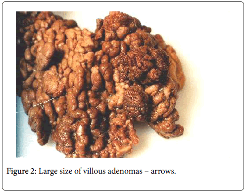 villous adenoma gross