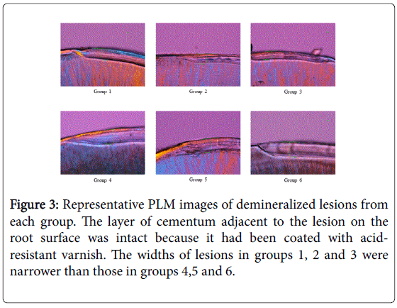 interdisciplinary-medicine-dental-science-demineralized-lesions-cementum