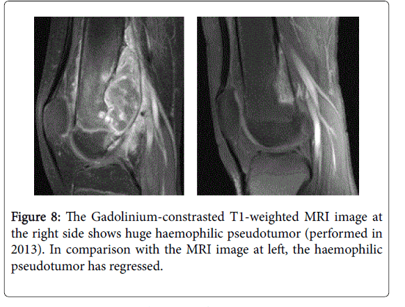 medical-reports-case-studies-haemophilic-pseudotumor