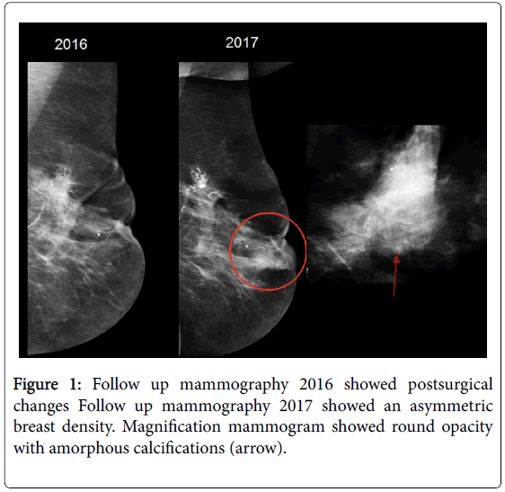 medical-reports-case-studies-mammography-postsurgical-mammogram