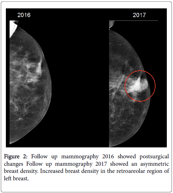 medical-reports-case-studies-mammography-postsurgical-retroareolar