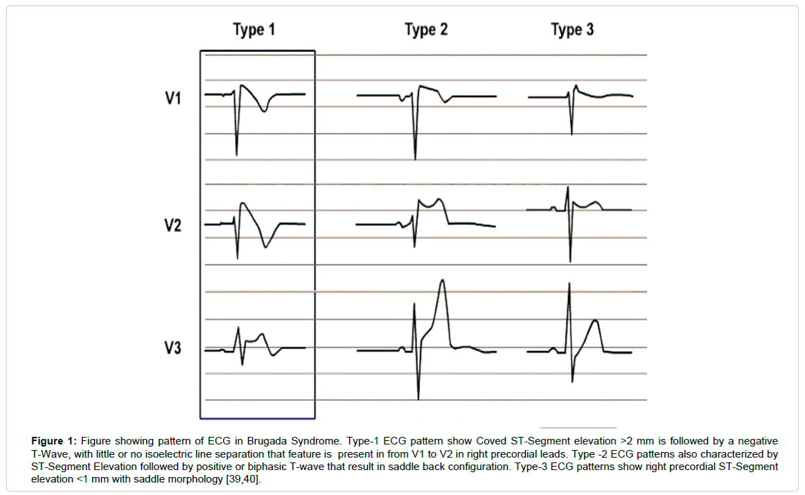 molecular-genetic-medicine-Brugada-Syndrome