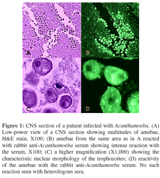 neuroinfectious-diseases-Acanthamoeba-serum