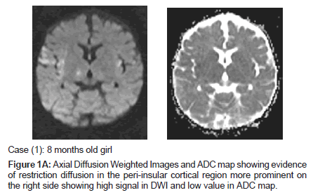 neuroinfectious-diseases-Axial-Diffusion