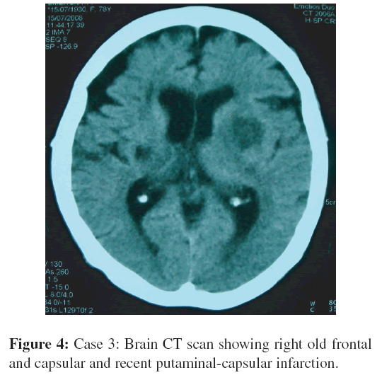 neuroinfectious-diseases-Brain-CT