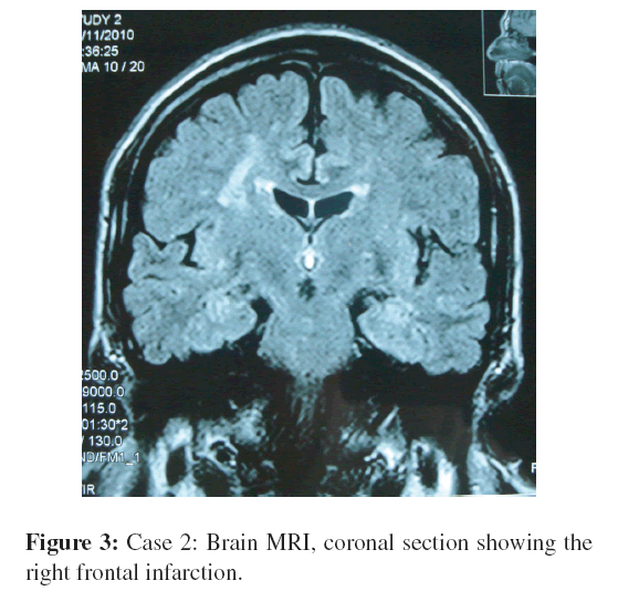 neuroinfectious-diseases-Brain-MRI