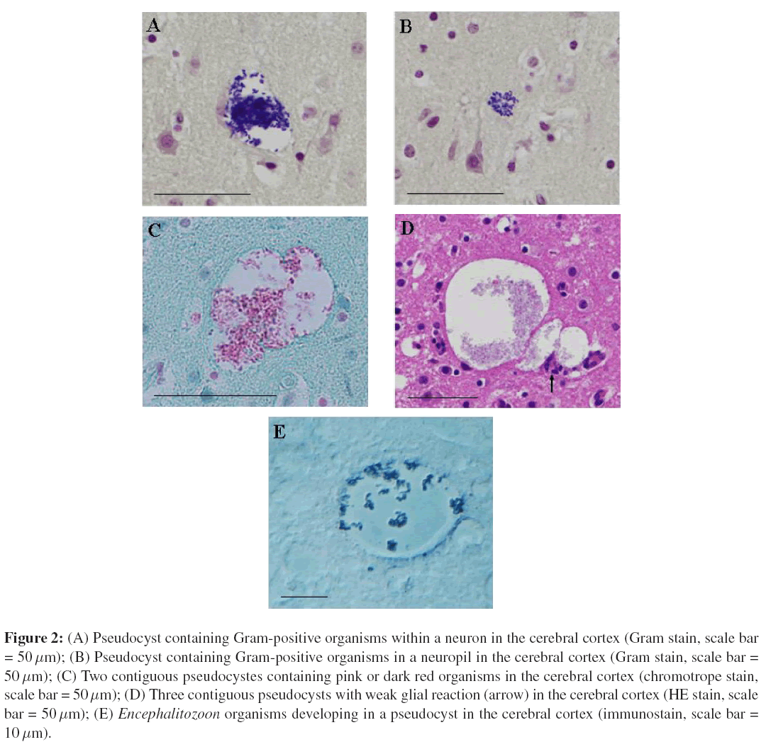 neuroinfectious-diseases-Pseudocyst-containing