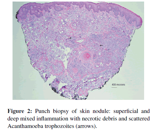 neuroinfectious-diseases-Punch-biopsy