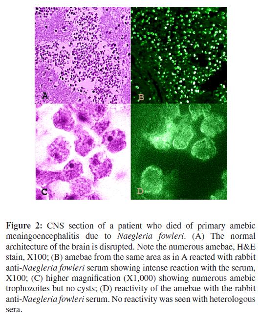 neuroinfectious-diseases-amebic-meningoencephalitis