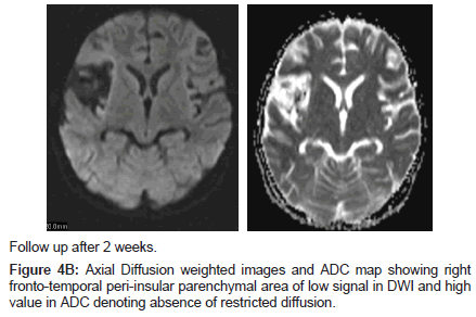 neuroinfectious-diseases-fronto-temporal-peri