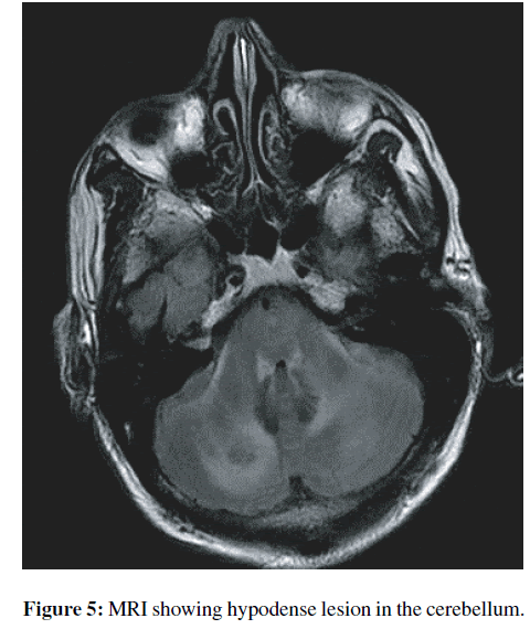 neuroinfectious-diseases-hypodense