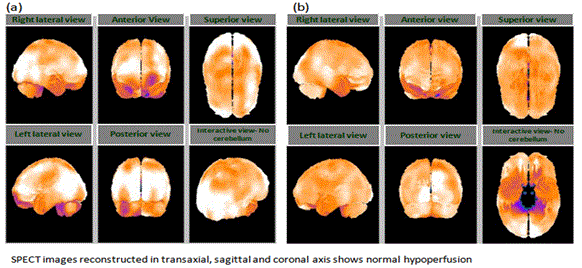 neuroinfectious-diseases-hypoperfusion