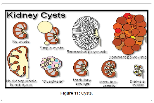 nuclear-medicine-Cysts