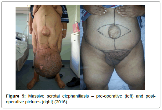 scrotal lymphedema