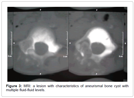 orthopedic-oncology-aneurismal-bone-cyst