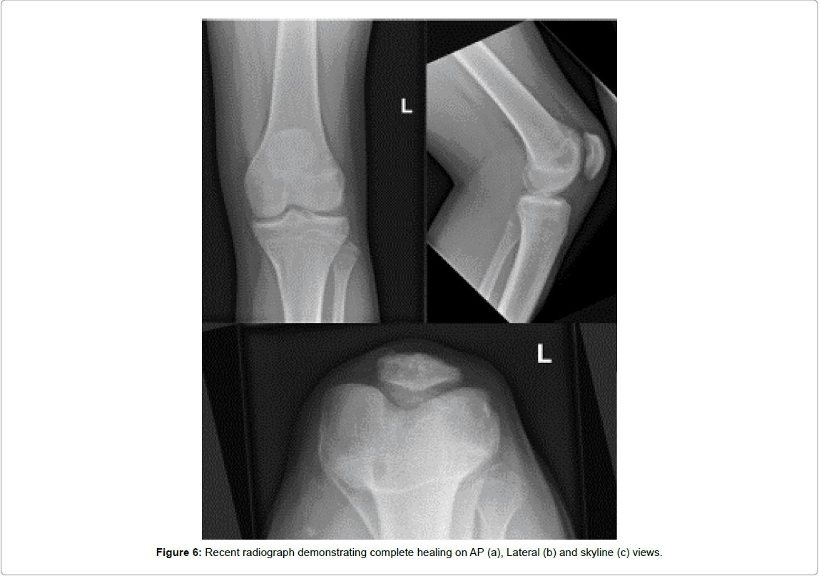 orthopedic-oncology-complete-healing