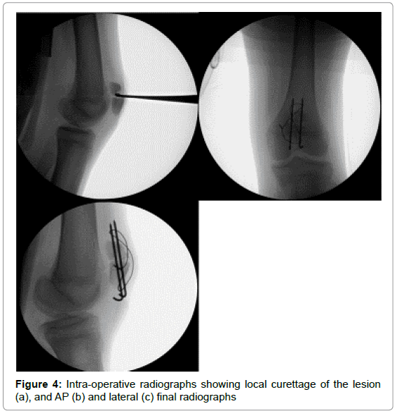 orthopedic-oncology-final-radiographs