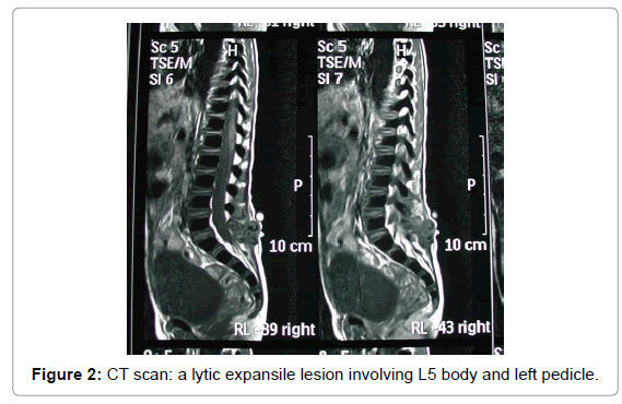 orthopedic-oncology-lytic-expansile-lesion