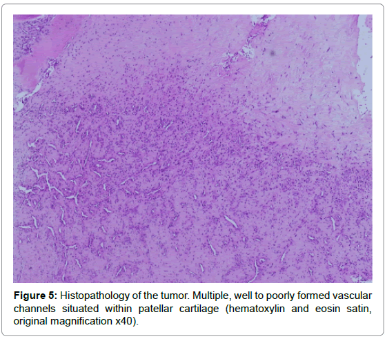 orthopedic-oncology-patellar-cartilage