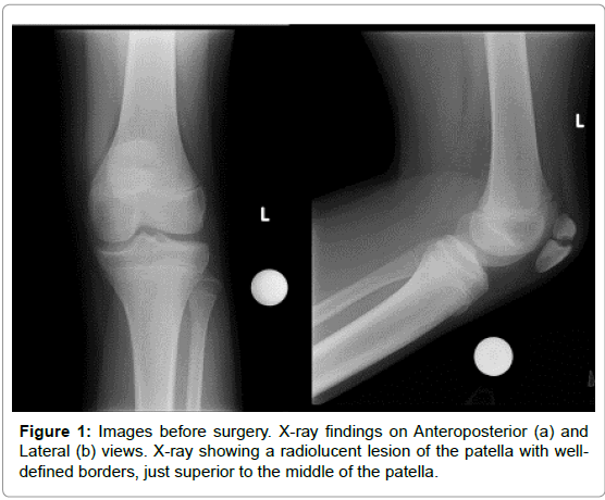 orthopedic-oncology-radiolucent-lesion