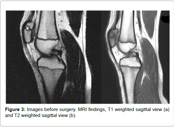 orthopedic-oncology-weighted-sagittal