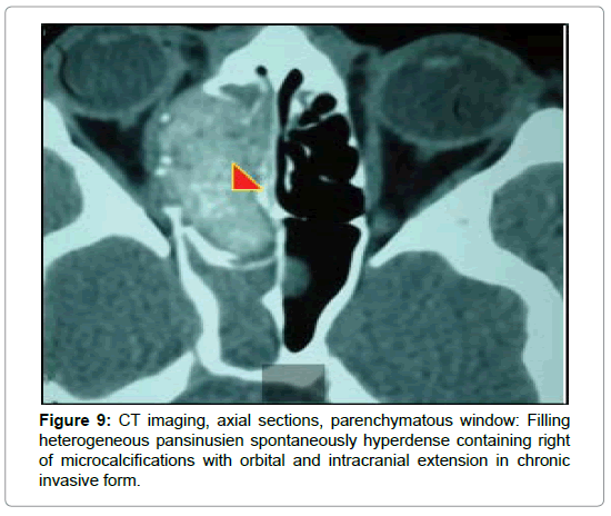 Treatment For 911 First Responders Chronic Sinusitis In Nyc