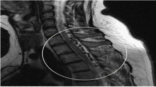 Mayer-Rokitansky-Kuster-Hauser Syndrome with Neurological Features